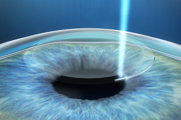 Femto LASIK